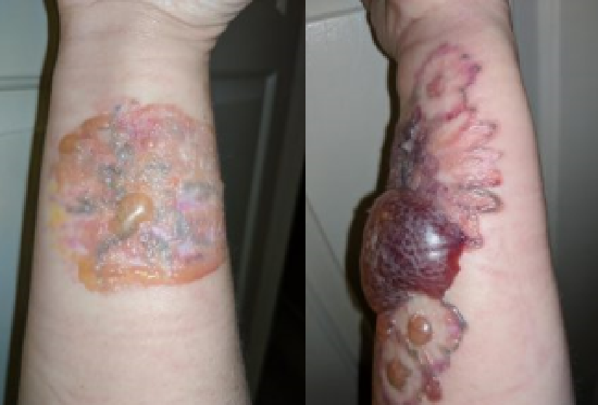 Going skin deep with Brenda Taylor: dealing with tattoo removal